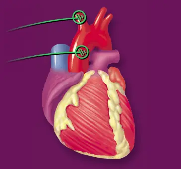 Baroreceptor Reflex Control of Blood Pressure logo
